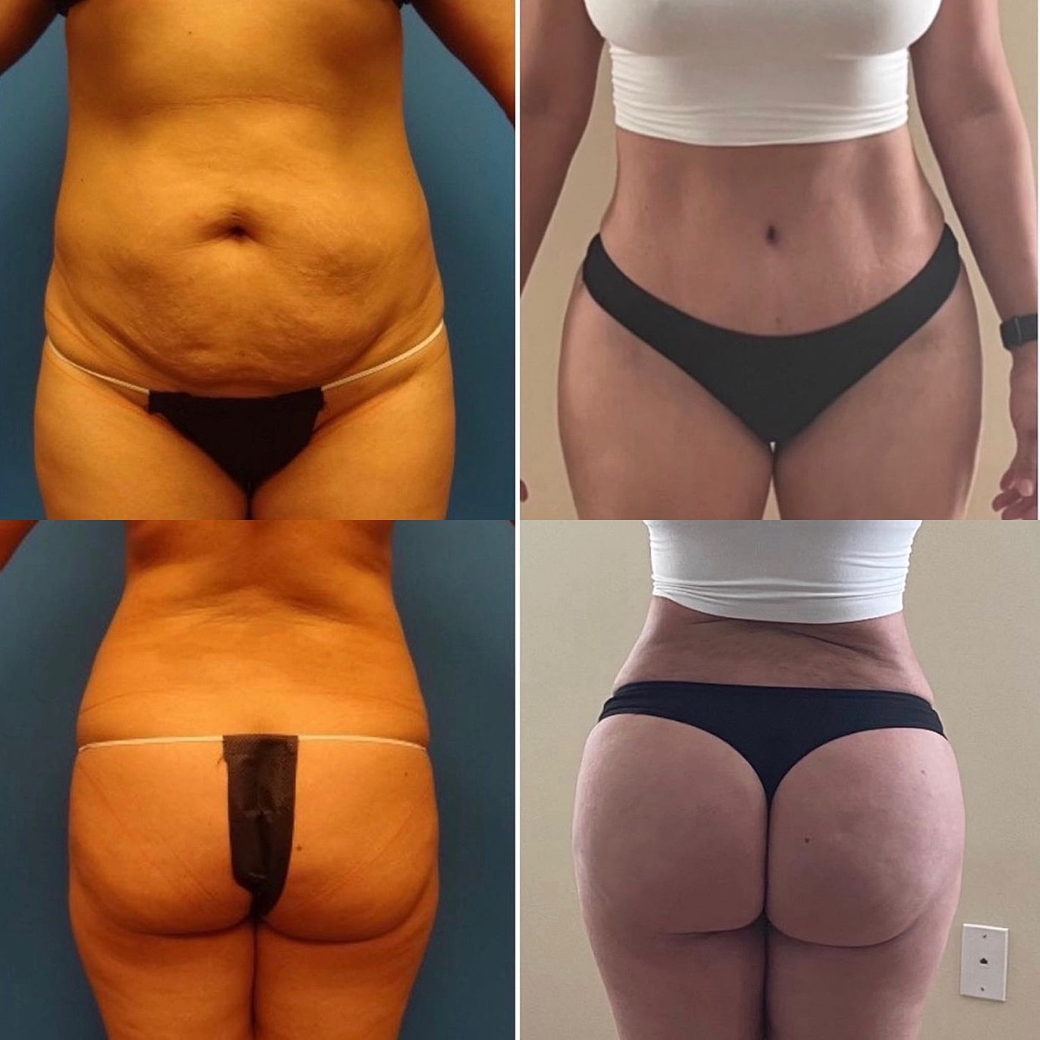 BBL - Fat Transfer Gallery Before & After