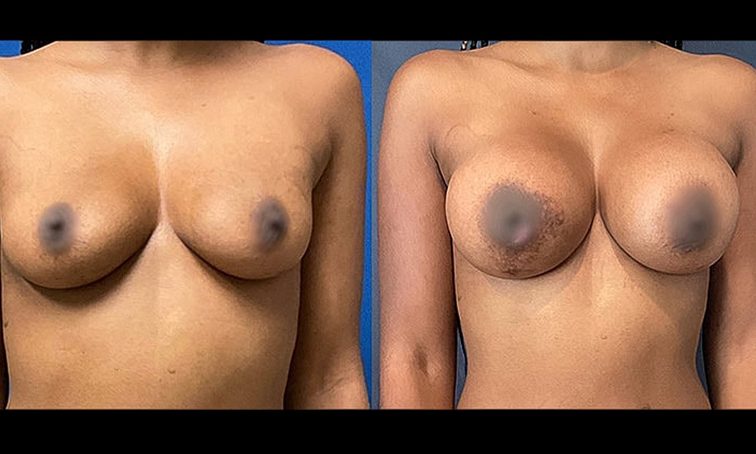 Breast Augmentation Gallery Before & After