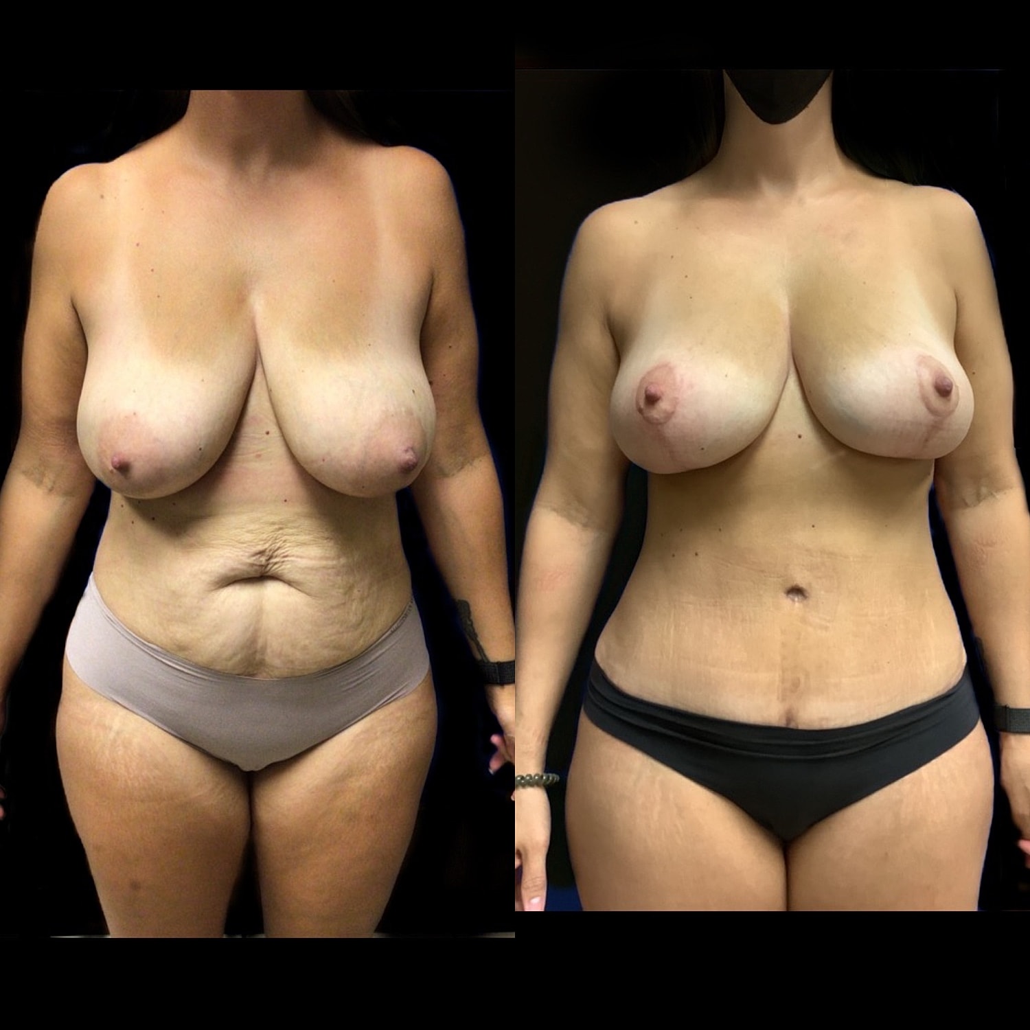 Mommy Makeover Gallery Before & After