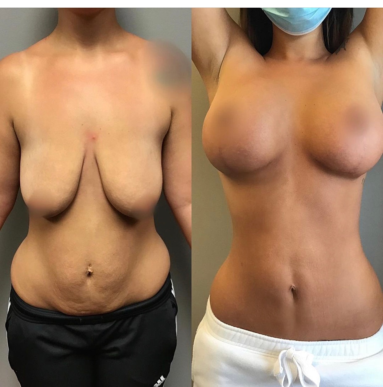 Mommy Makeover Gallery Before & After