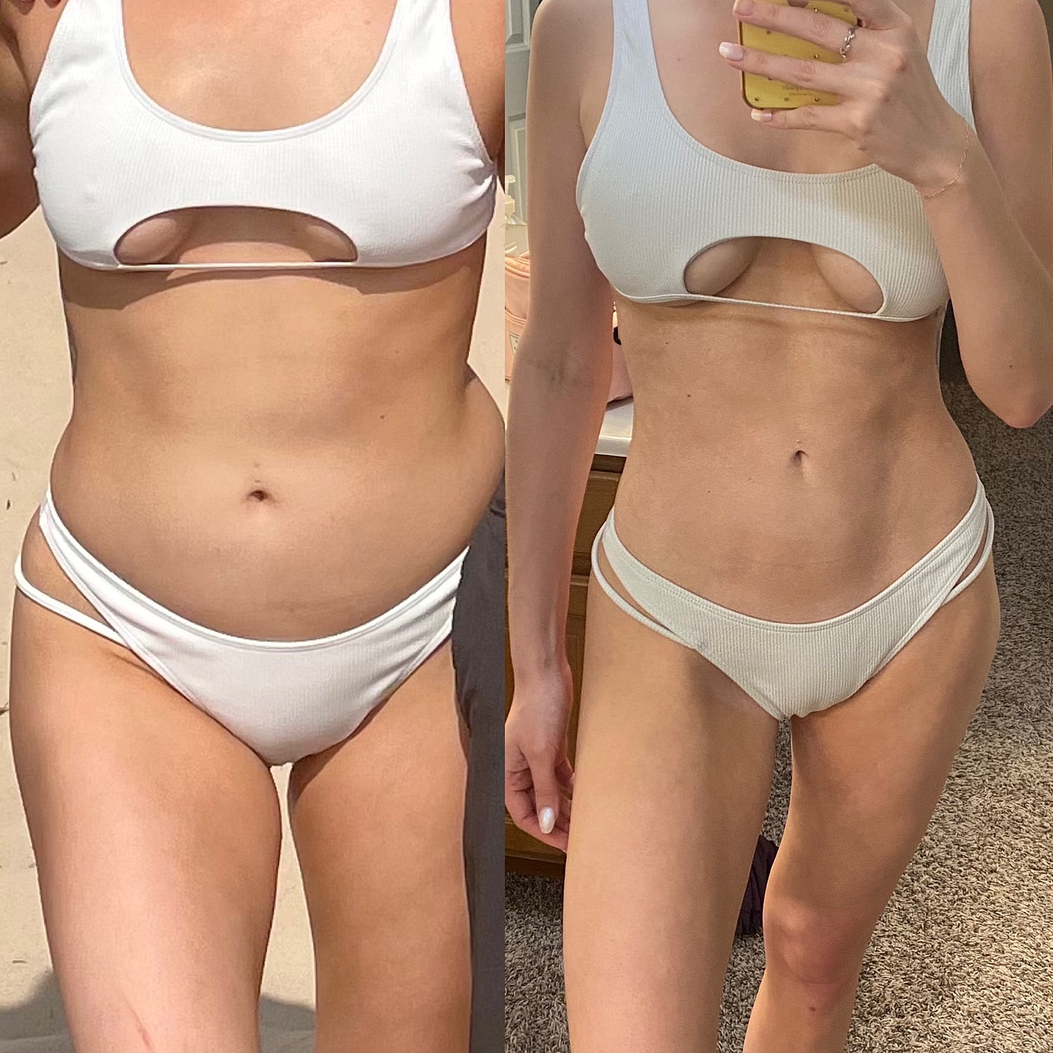 Liposuction Gallery Before & After