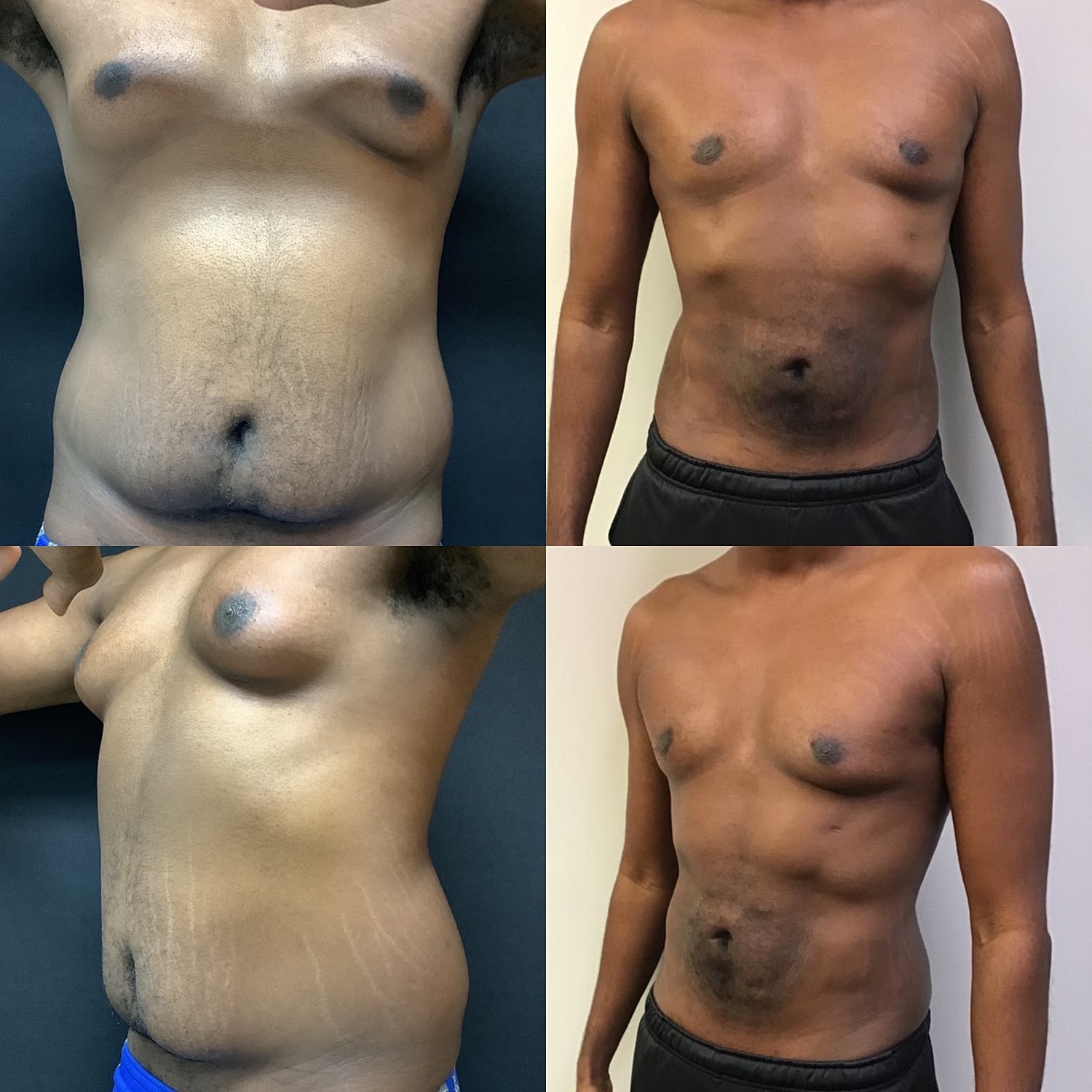 Liposuction Gallery Before & After